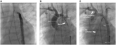 Case Report: Trans-axillary Artery Access for Rescue Stent Implantation in an Infant With Retrograde Non-passable Aortic Coarctation